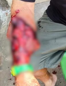 Idoso sofre ferimentos graves ao ser atacado por pitbull no centro de Gurupi