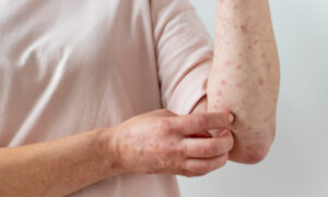 Secretaria de Saúde confirma dois casos de sarampo no Tocantins